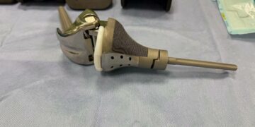 В Самаре выполнили редкую операцию: удаление опухоли коленного сустава с протезированием