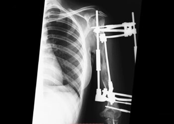 Врачи в Самаре успешно провели операцию по удлинению руки пациента на 13 сантиметров