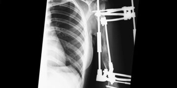 Врачи в Самаре успешно провели операцию по удлинению руки пациента на 13 сантиметров